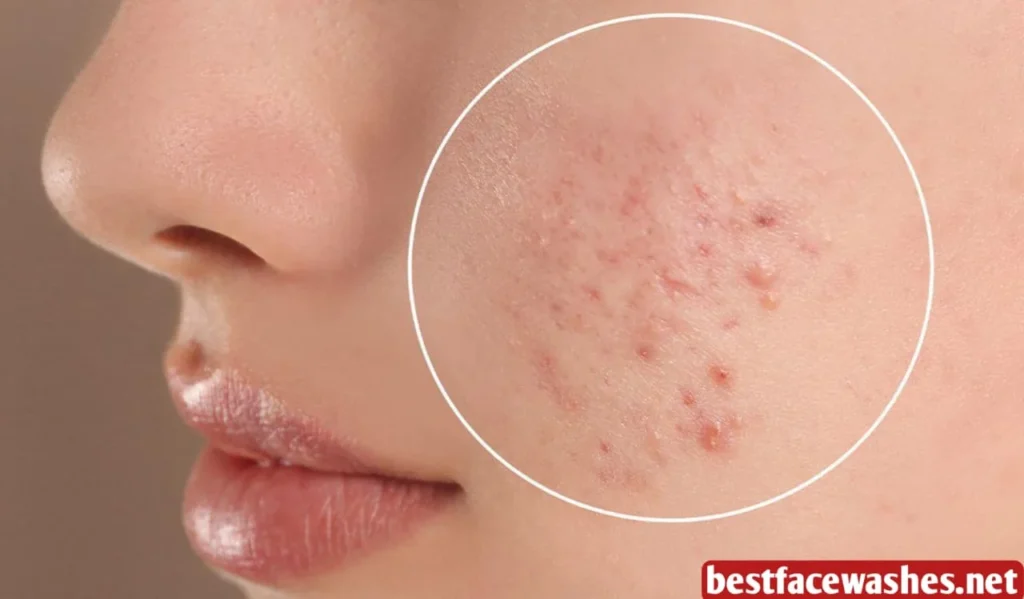 How Acne Develops on the Skin