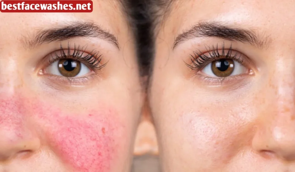 Soothes Irritation and Reduces Redness