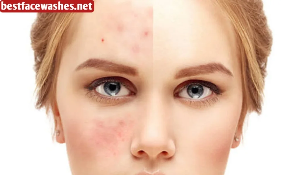 Reduces Acne-Causing Bacteria