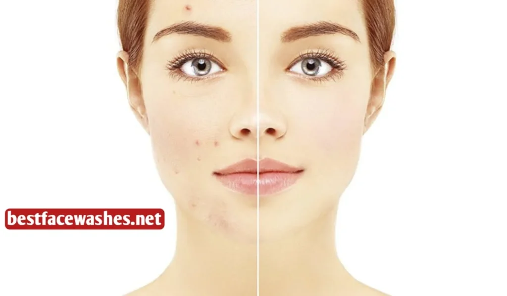 Fights Acne-Causing Bacteria