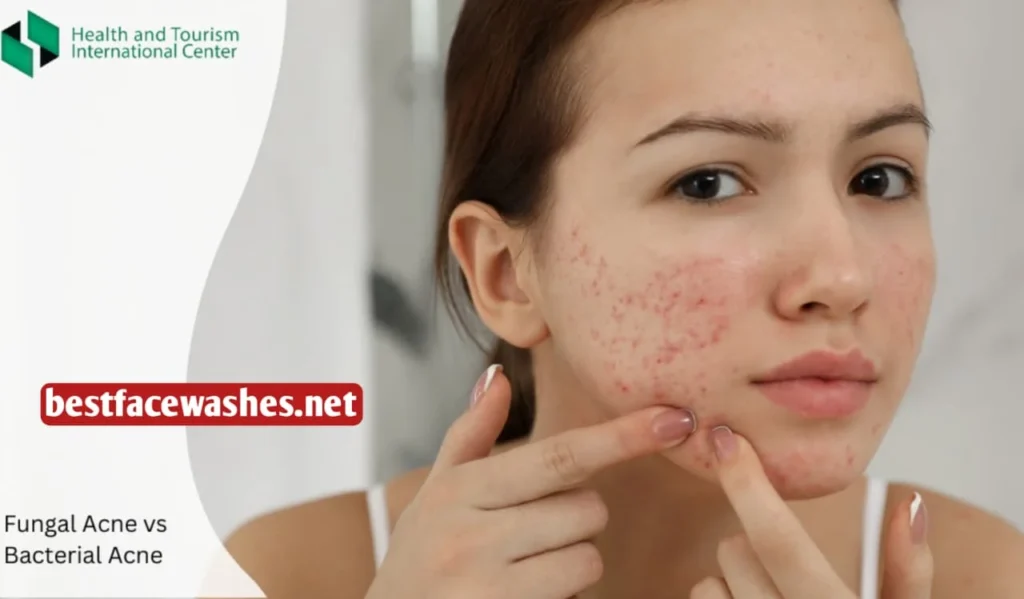 Reduces Acne-Causing Bacteria