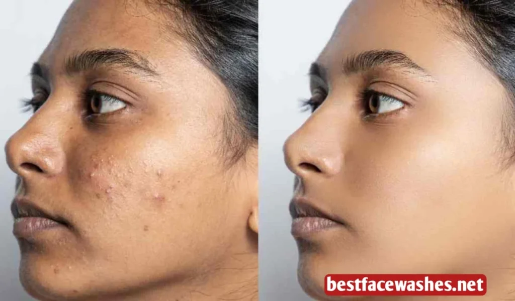 Why Oily Skin Often Looks Dull