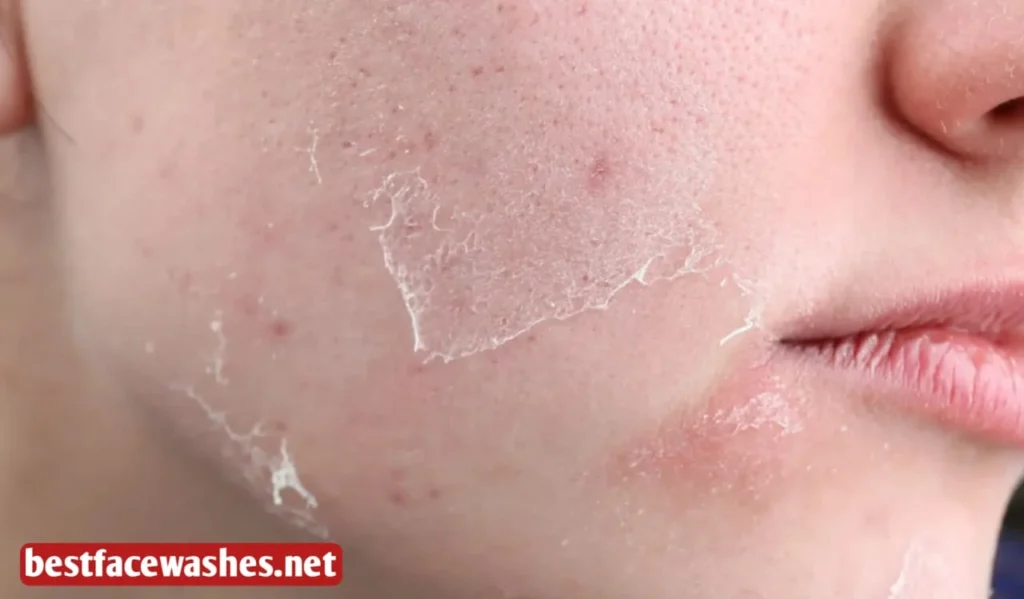 Why Skin Becomes Flaky