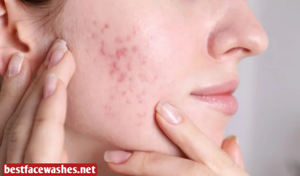 What Causes Post Acne Marks