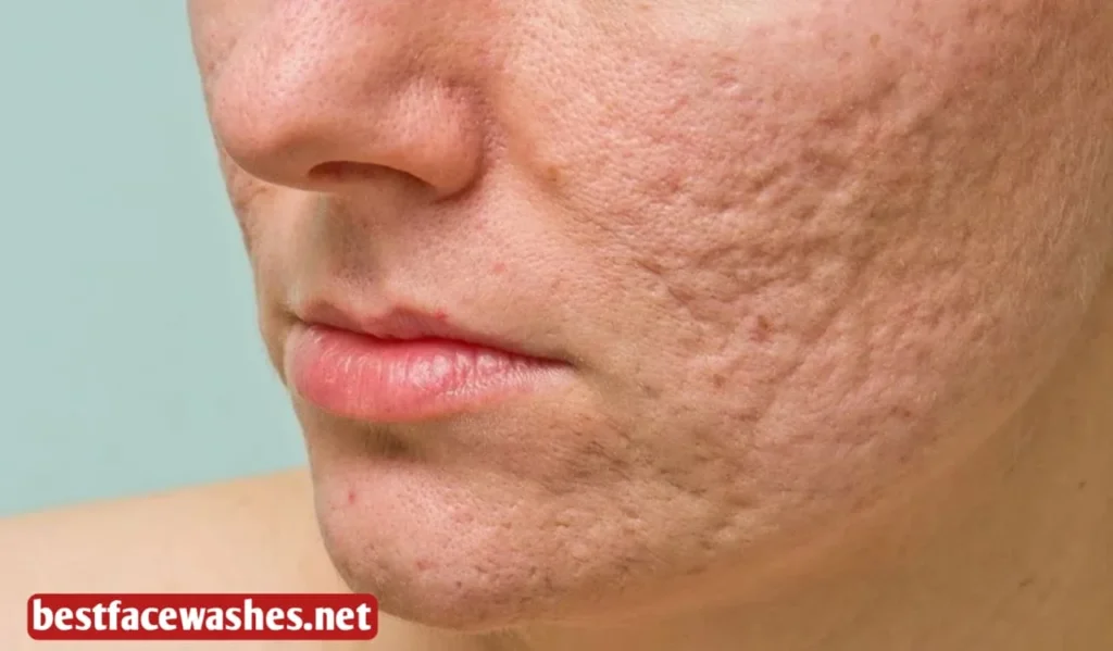 Why Skin Becomes Scar-Prone