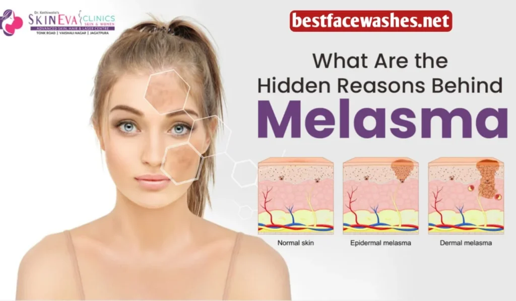 What Triggers Melasma Worsening