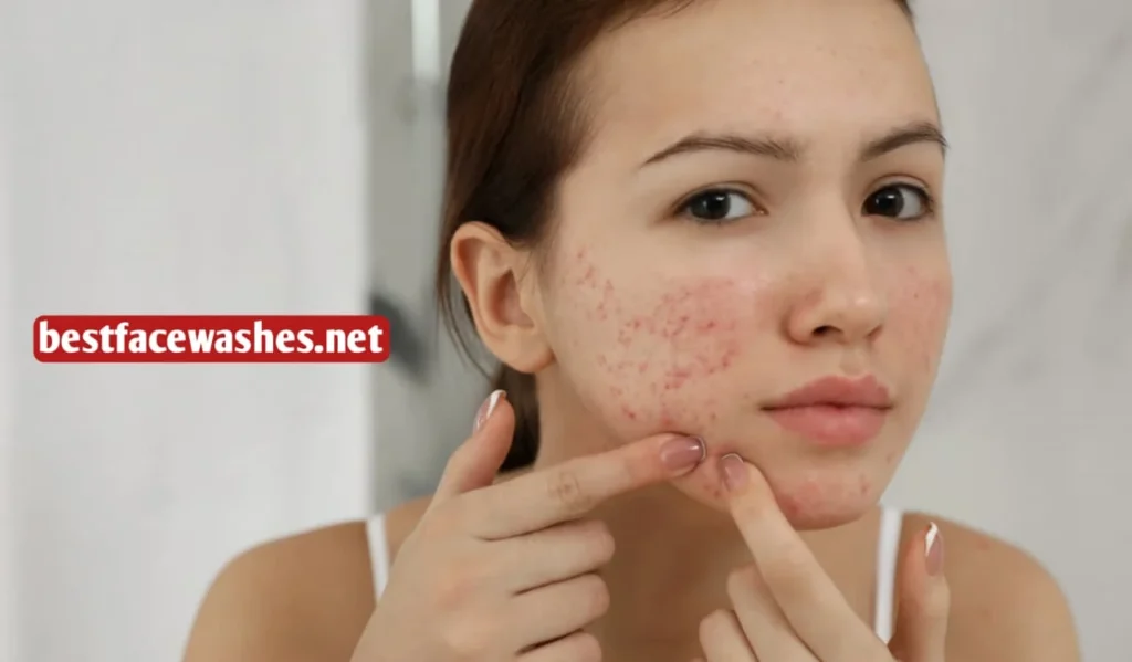 Why Teenage Skin Gets Pimples