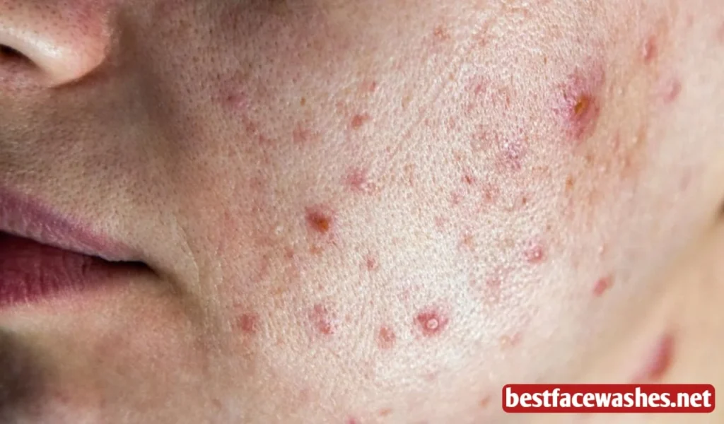 Understanding Why Breakouts Happen